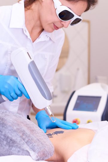 Tattoo removal in the clinic